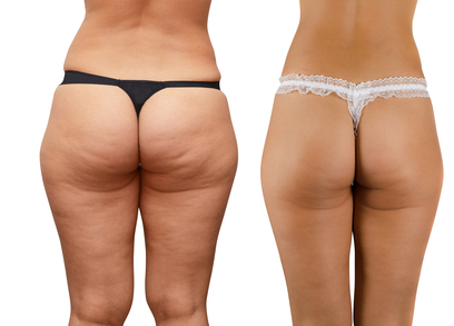 cellulite reduction from cellulite factor