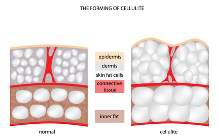 cellulite formation diagram